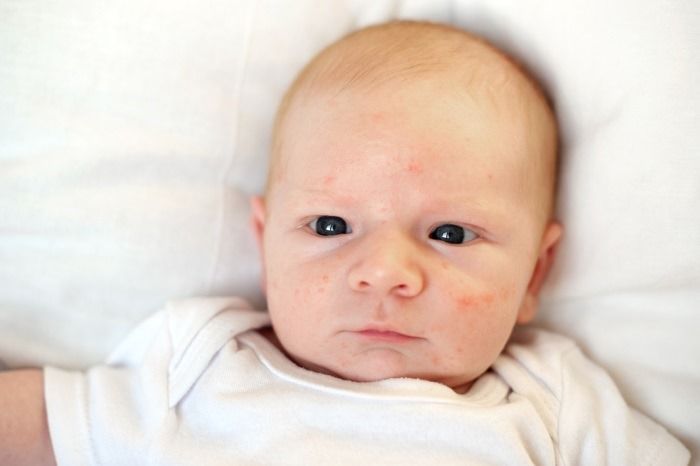 Как лечить акне новорожденных комаровский