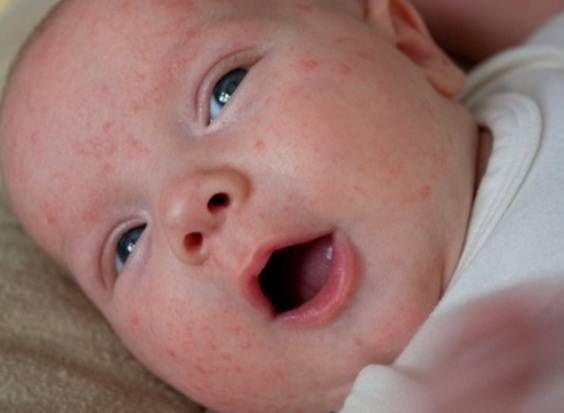 Как лечить акне новорожденных комаровский
