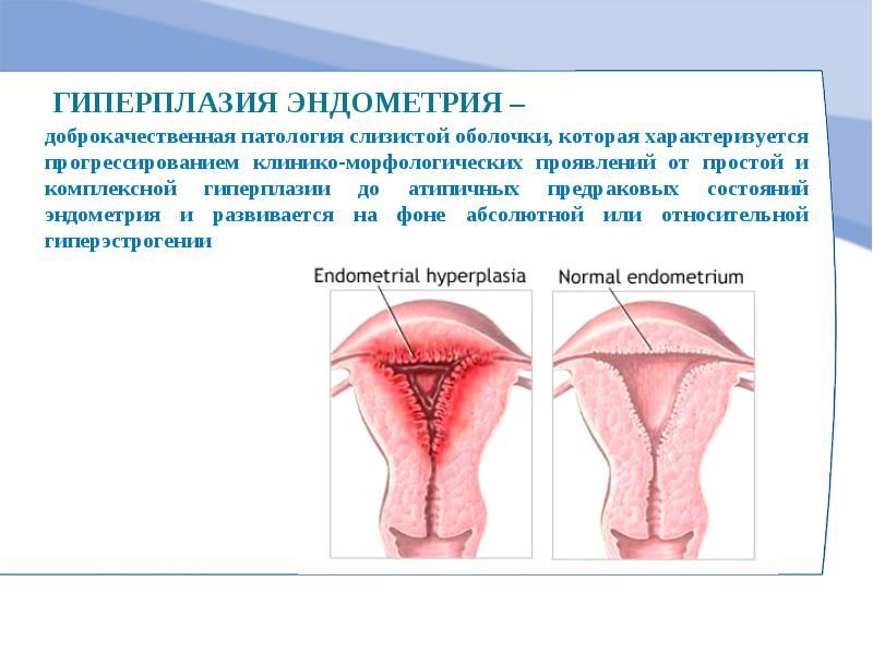 Причины эндометрия у женщин. Гиперплазия эндометрит. Ультразвуковые критерии гиперплазии эндометрия. Гиперплазия эндометрия матки что это.