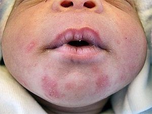 Гнойничковая сыпь на коже у новорожденных