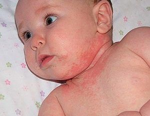 Сыпь у новорожденного на лице как гнойнички