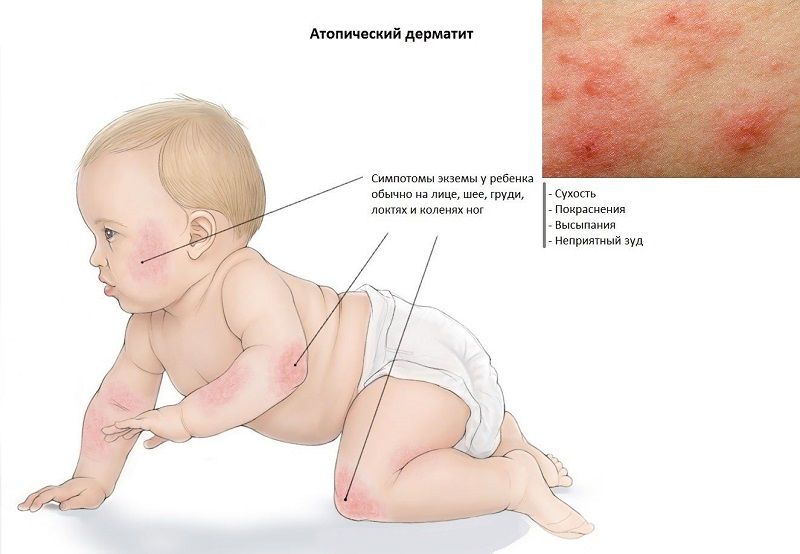 Гнойничковая сыпь на коже у новорожденных