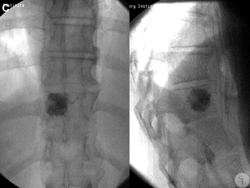 Гемангиома грудного отдела позвоночника. Гемангиома вертебропластика. Гемангиома позвоночника l1. Гемангиома л2 позвонка. Гемангиома позвоночника l3.