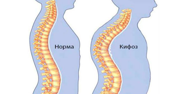 Здоровый изгиб позвоночника