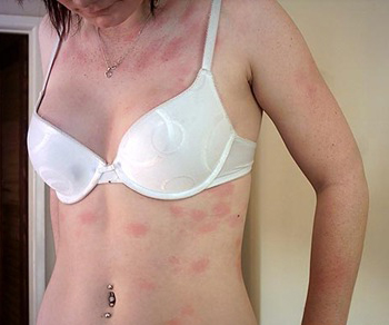 как выглядит аллергия на коже