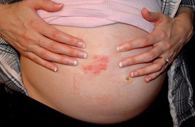 Себорейный дерматит и беременность