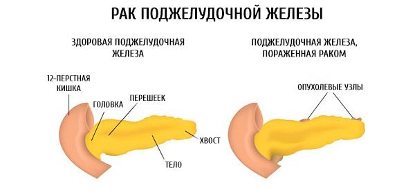 Рак поджелудочной железы сколько живут