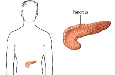 Рак поджелудочной железы 2 стадия