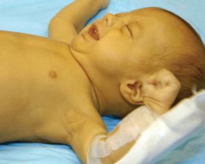 Лечение желтухи у новорожденных