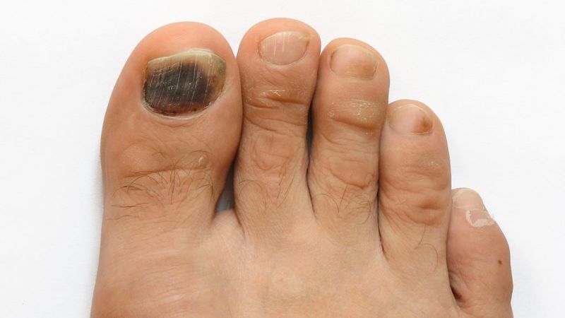 Ушиб ногтя на ноге лечение