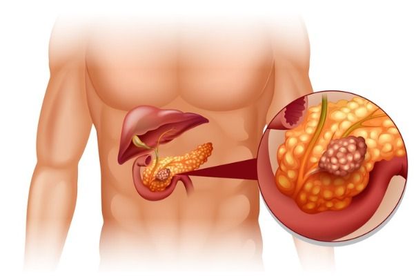 Прогноз при раке поджелудочной железы