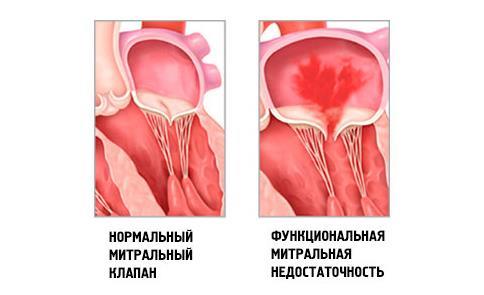 Фиброз клапанов сердца лечение