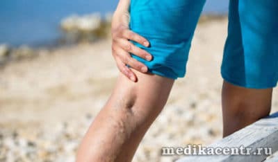 Флебома что это такое у женщин