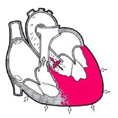 Утолщение стенок сердца лечение