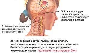 Частые мигрени и головные боли