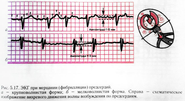 Формы мерцательной аритмии сердца