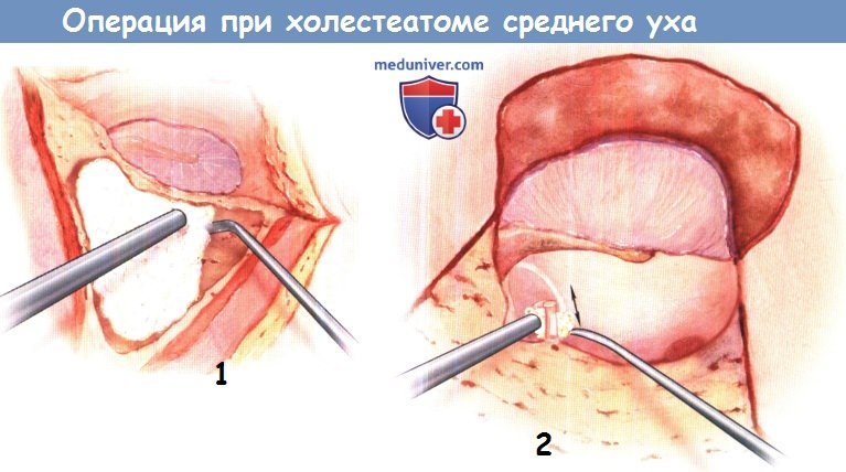 Холестеатома в ухе операция цены