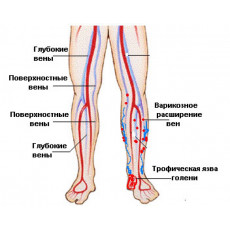 Химотрипсин при трофических язвах