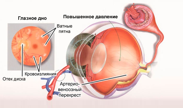 Чем лечить внутриглазное давление