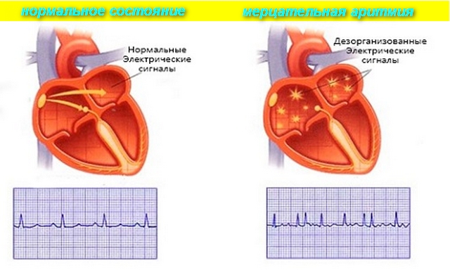 Что выпить при аритмии сердца