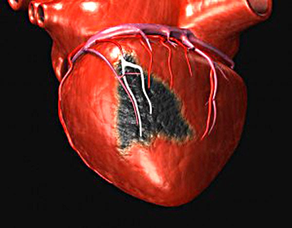 Этиопатогенез инфаркта миокарда