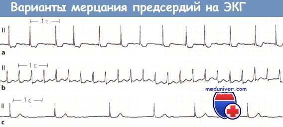 Пароксизмальная фибрилляция предсердий карта вызова