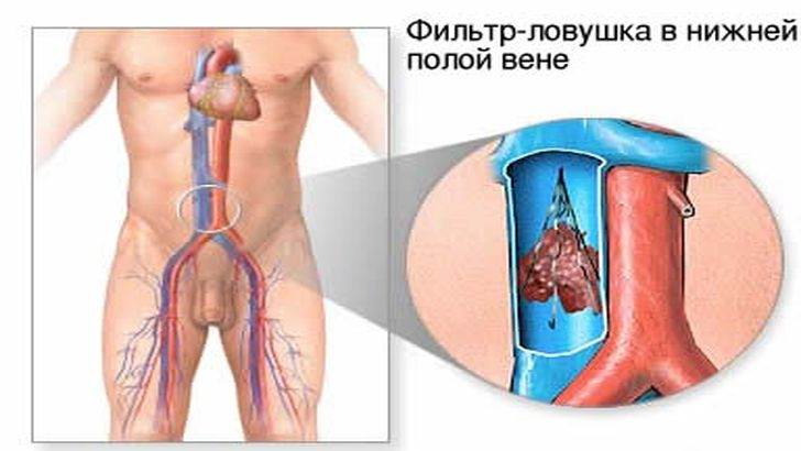 Что делает ловушка для тромбов