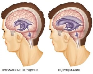 Шунт в голове при гидроцефалии