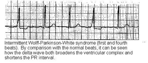 Wolff parkinson white syndrome