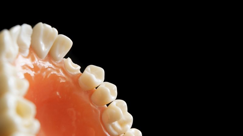 Кариес зубов: симптомы и лечение